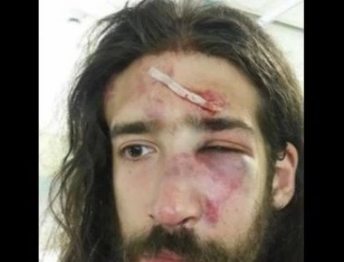 Ξυλοκοπήθηκε ενώ περίμενε στη στάση του λεωφορείου να πάει σε συναυλία